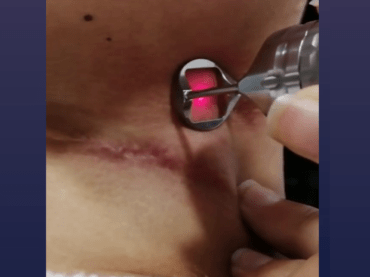 Fractional laser for scar treatment