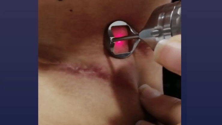 Laser fractionné pour traitement des cicatrices