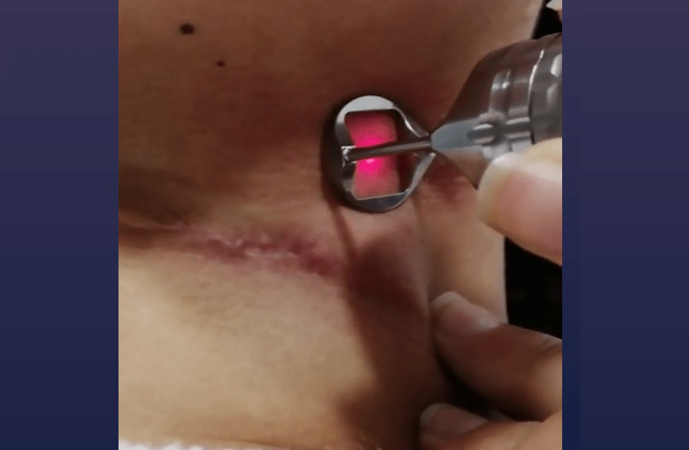 Laser fractionné pour traitement des cicatrices
