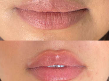 Augmentation des lèvres harmonieuse et naturelle