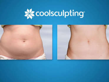 Coolsculpting: non-surgical solution without pain