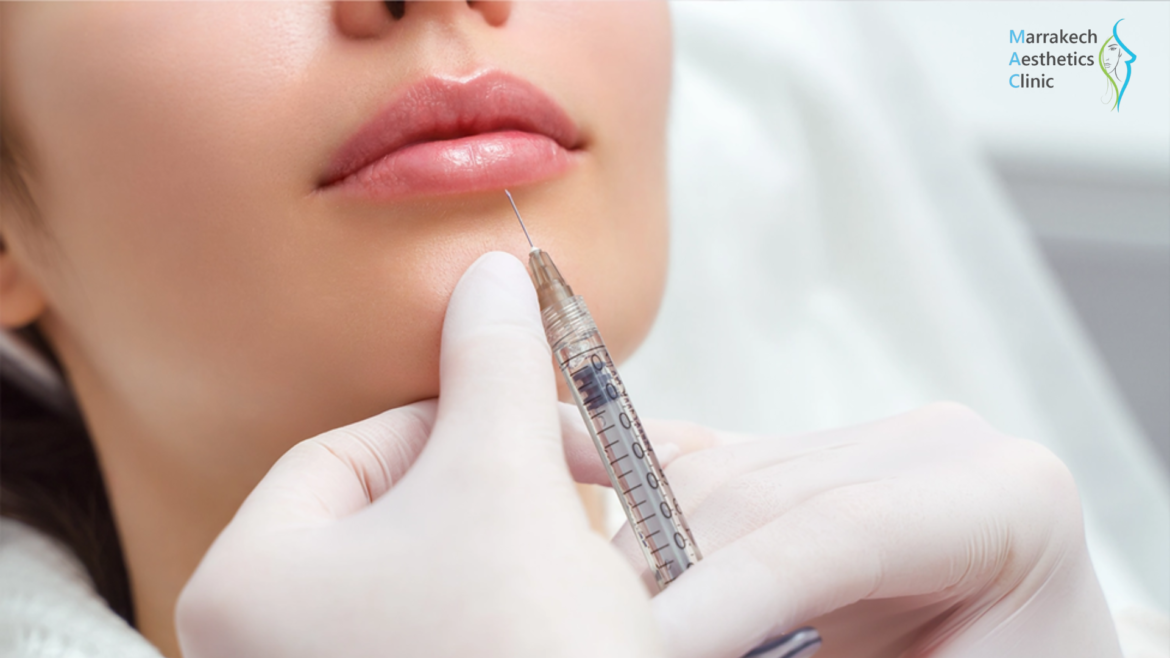 À quoi s’attendre après des injections de fillers ? Résultats, effets secondaires, durée