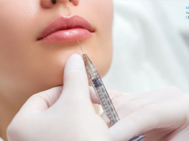 À quoi s’attendre après des injections de fillers ? Résultats, effets secondaires, durée