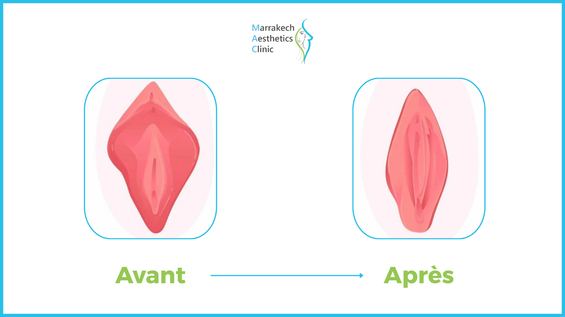 lipofilling des grandes lèvres