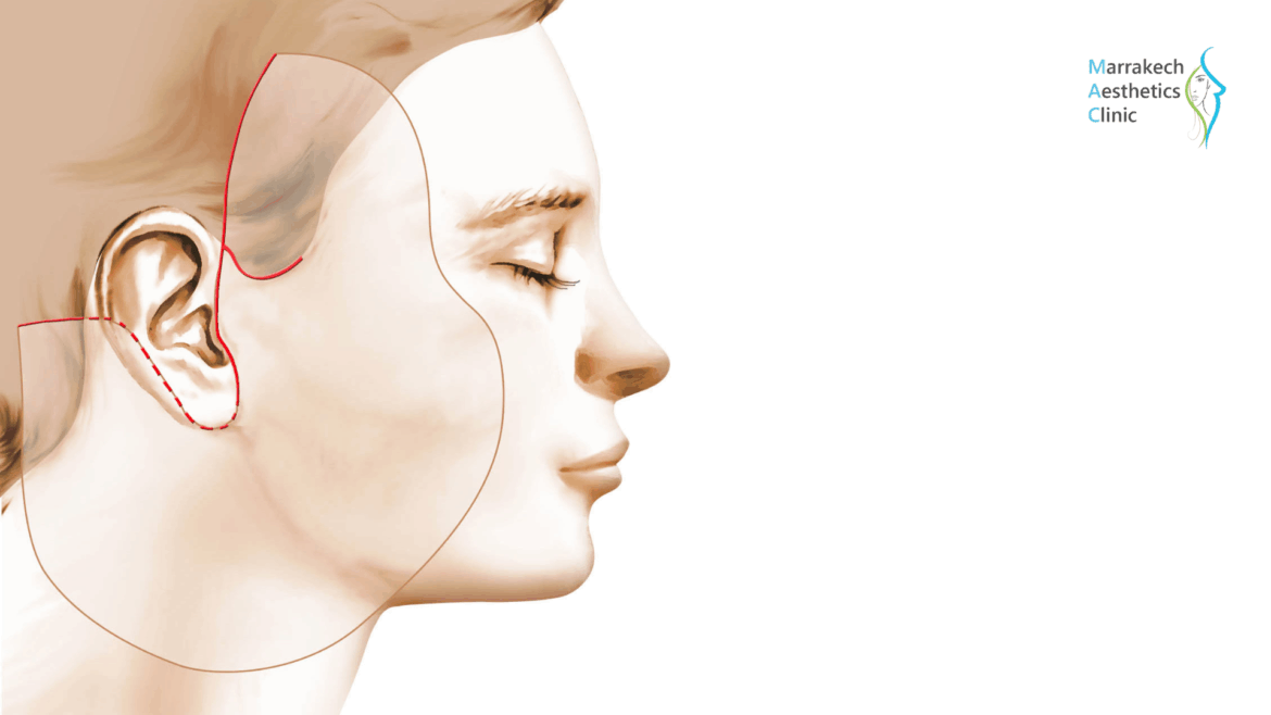 À quel âge envisager un lifting cervico-facial ?