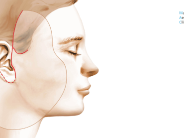 À quel âge envisager un lifting cervico-facial ?