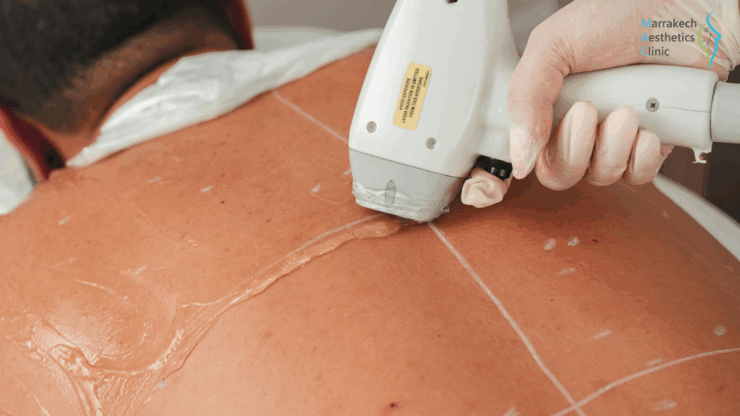 Pourquoi certaines zones résistent-elles à l’épilation laser ? (menton, maillot, dos…)